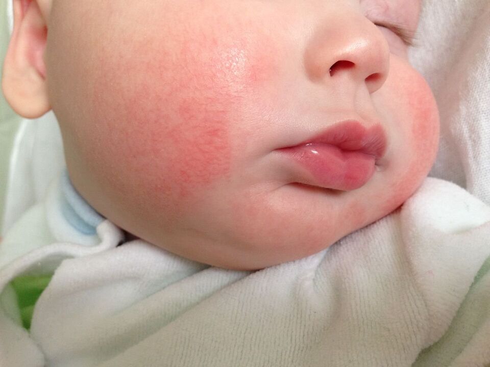 Un semn al viermilor la un copil este urticaria alergică